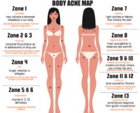 Acne Location Chart