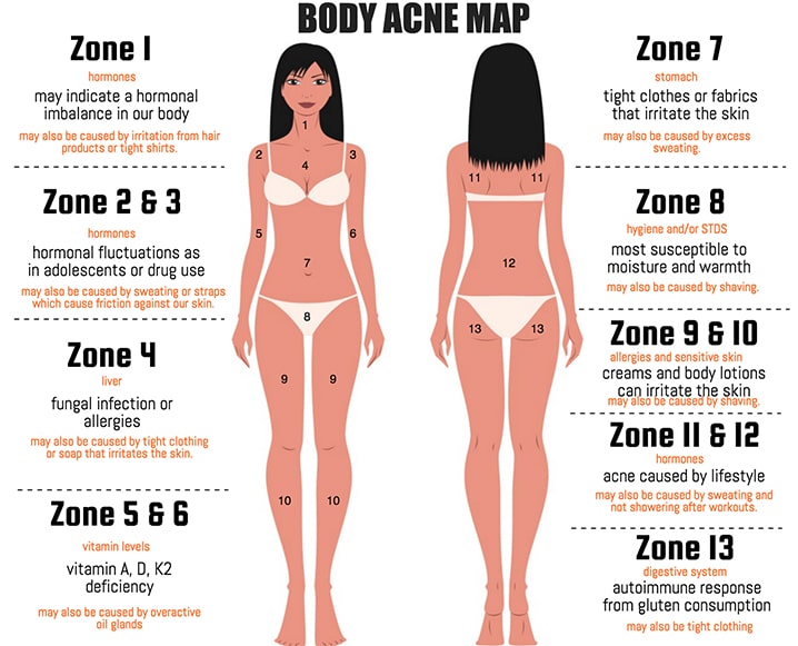 Pimples On Body Chart