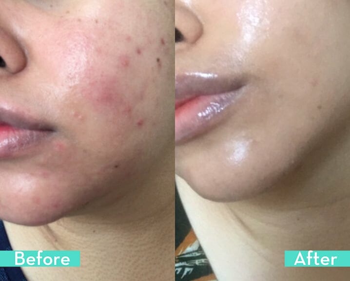 skincare before and after hum supplement Saved My Skin