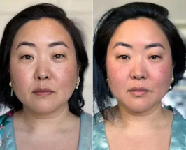 facial gua sha before and after