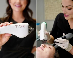 moxi laser treatments